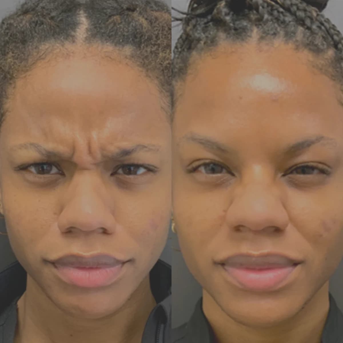 Smoothed forehead and softened glabellar (frown) lines after a Botox treatment at Chin Up Aesthetics.